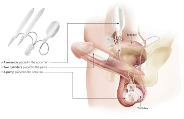 corinne cheney recommends old man penile implant videos porn pic