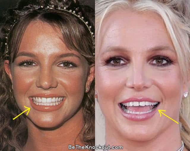 Best of Britney braces