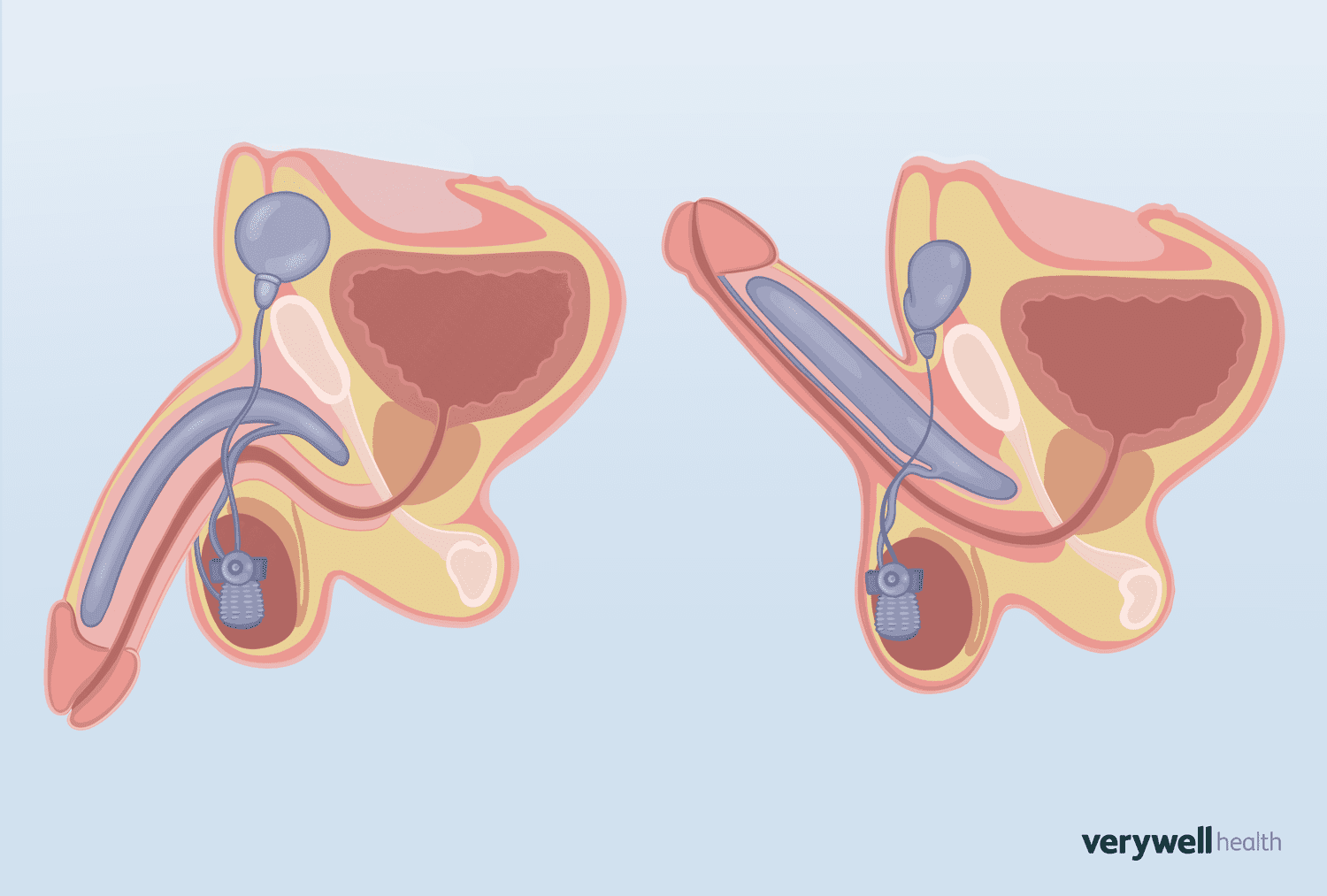 craig seale add penile implant porn photo